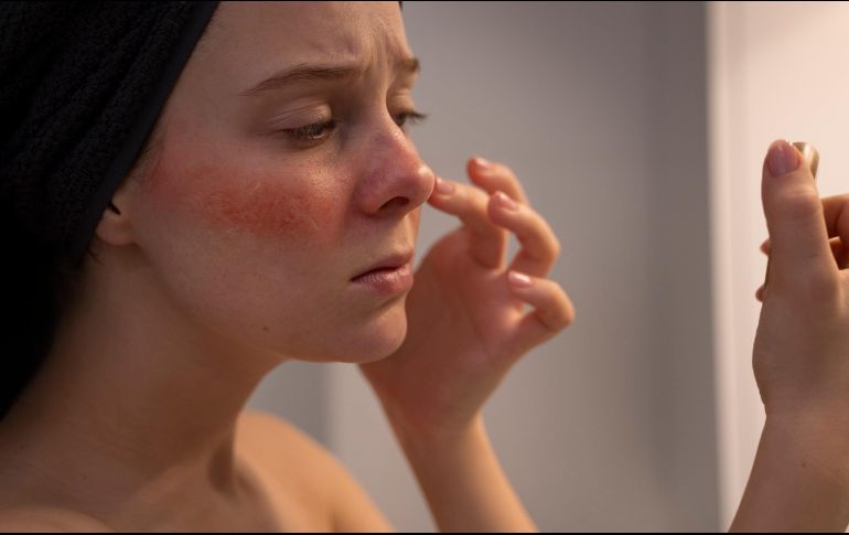 Es una de las enfermedades cutáneas más prevalentes en el mundo y la que tiene poco reconocimiento. ESPECIAL/ Freepik