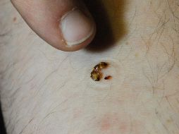 De acuerdo con información de Mayo Clinic las heridas sanan solas en el lapso de una y dos semanas.AFP/Archivo