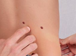 Los lunares aparecen por lo general como pequeños puntos marrones u oscuros, y son causados por grupos de células que producen la pigmentación. ESPECIAL/ UNSPLASH