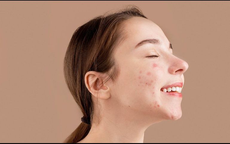 Un estudio clínico realizado en 2020 concluyó que el abuso en el uso del móvil empeoraba el acné. Unsplash.