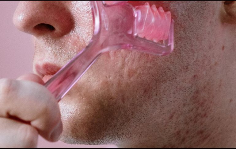 El cloracné es una enfermedad cutánea crónica de tipo acné que se produce por la sobre exposición a ciertos hidrocarburos aromáticos halogenados. Pexels.