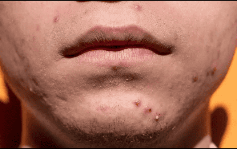 La vitamina A emerge como un elemento crucial en la batalla contra las imperfecciones de la piel. Pixabay.