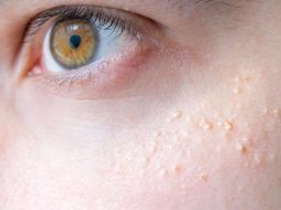 El acné es una afectación que millones de personas poseen. SUN/ARCHIVO