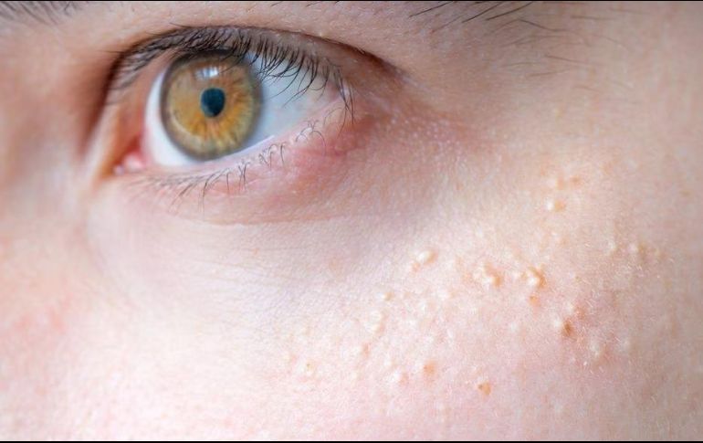 Este problema de piel no produce dolor. SUN/ARCHIVO