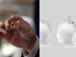 La noticia de la primera operación hecha por Neuralink es un hito importante para la compañía. ESPECIAL / NEURALINK / AFP