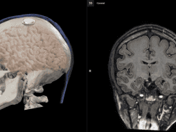 De acuerdo con el CEO de Neuralink, la compañía busca brindar la oportunidad a los pacientes de mover el mouse en varias direcciones. ESPECIAL / NEURALINK