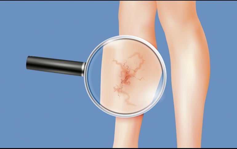 Las várices presentan un tono morado o azulado debido a la acumulación de sangre en estos conductos. ESPECIAL