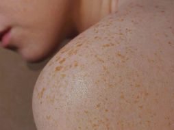 Existen tres tipos principales de cáncer de piel: carcinoma basocelular, carcinoma espinocelular y melanoma. UNSPLASH / V. Smirnova