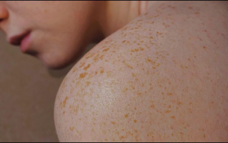 Existen tres tipos principales de cáncer de piel: carcinoma basocelular, carcinoma espinocelular y melanoma. UNSPLASH / V. Smirnova