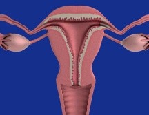 La endometriosis es una enfermedad crónica e inflamatoria. Pixabay.