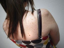 La aparición de pecas es mucho más frecuente en pacientes pelirrojos y rubios. EL INFORMADOR / ARCHIVO