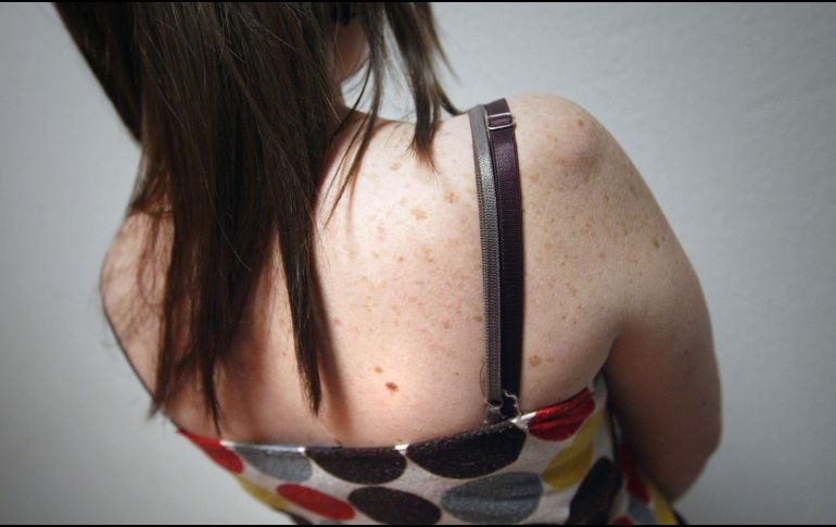 La aparición de pecas es mucho más frecuente en pacientes pelirrojos y rubios. EL INFORMADOR / ARCHIVO