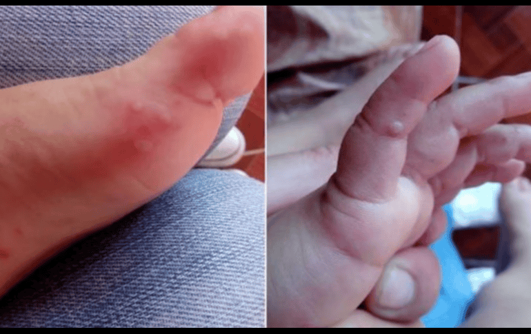 El salpullido rojo en las manos y pies puede convertirse en ampollas. SUN / ARCHIVO