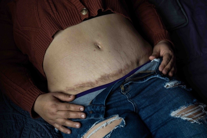 &nbsp;Las cirugías estéticas mal realizadas pueden ser mortales, o incluso dejar secuelas de por vida. SUN/ ARCHIVO