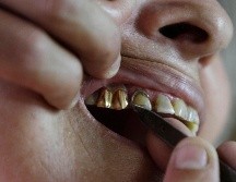 Especialistas resaltaron que la clave para evitar estos problemas es atender la salud dental desde la infancia, lo que evitará que en la edad adulta haya problemas. AP / ARCHIVO