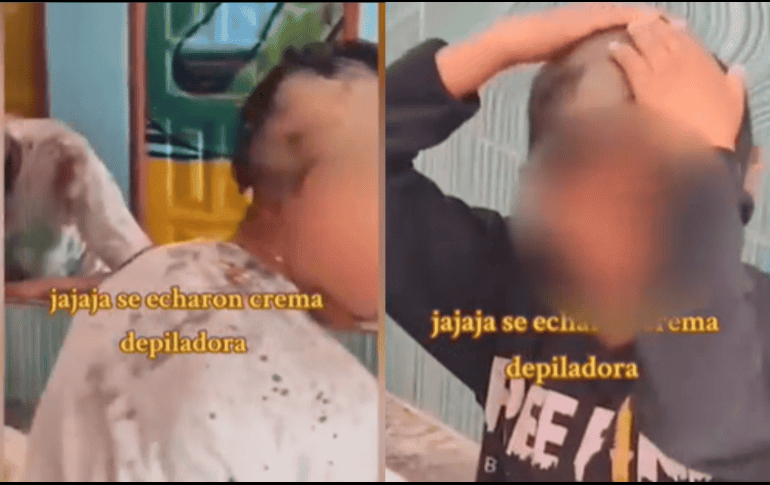 Aparentemente este suceso se debió a un ingenuo error, al confundir champú para el cabello con un tratamiento depilatorio. ESPECIAL.