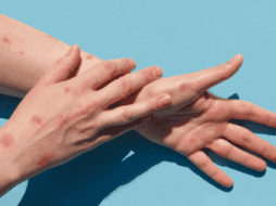 Según la Organización Panamericana de la Salud (OPS), la viruela del mono se transmite a través del contacto directo o indirecto con sangre, fluidos corporales, lesiones cutáneas o mucosas de animales infectados. ESPECIAL/Gobierno de México