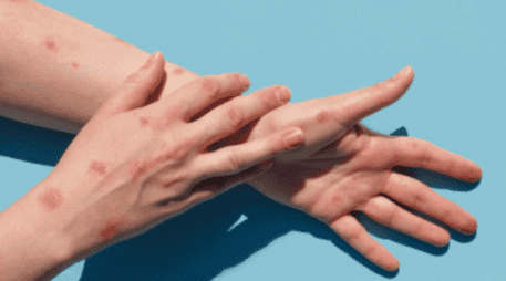 Según la Organización Panamericana de la Salud (OPS), la viruela del mono se transmite a través del contacto directo o indirecto con sangre, fluidos corporales, lesiones cutáneas o mucosas de animales infectados. ESPECIAL/Gobierno de México