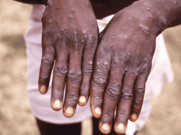 La viruela símica se caracteriza por erupción o lesiones cutáneas que suelen concentrarse en la cara, las palmas de las manos y las plantas de los pies. AP / ARCHIVO
