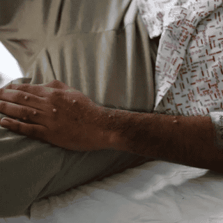 Este es el plan de la OMS para atender la mpox