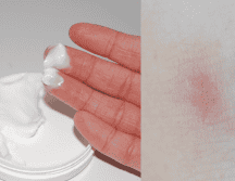 Barmicil es una crema que se utiliza para combatir irritaciones, sequedad, enrojecimiento y picazón de la piel. ESPECIAL/Imagen de Mizianitka en Pixabay/ Imagen de Angela Roma en Pexels