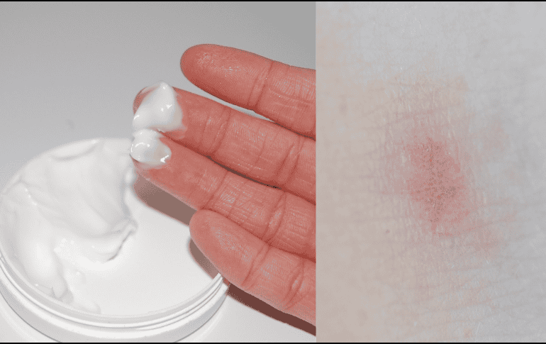 Barmicil es una crema que se utiliza para combatir irritaciones, sequedad, enrojecimiento y picazón de la piel. ESPECIAL/Imagen de Mizianitka en Pixabay/ Imagen de Angela Roma en Pexels