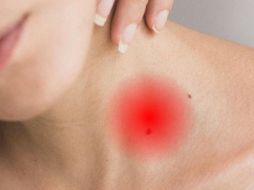 Las picaduras suelen desaparecer al cabo de una a dos semanas. UNSPLASH / A. ECHEVERRY