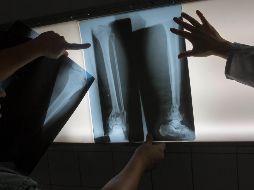 Los esguinces en los tobillos son una de las causas más frecuentes de dolor. AP / ARCHIVO