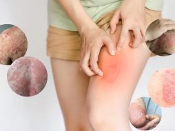 La psoriasis es una enfermedad autoinmune que provoca la aceleración del ciclo de vida de las células de la piel, lo que resulta en la formación de escamas y parches rojos que pueden ser dolorosos y picar. CANVA