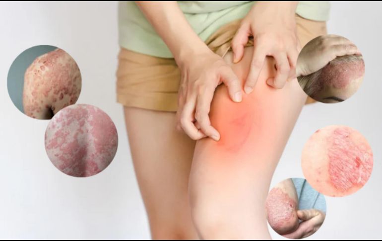 La psoriasis es una enfermedad autoinmune que provoca la aceleración del ciclo de vida de las células de la piel, lo que resulta en la formación de escamas y parches rojos que pueden ser dolorosos y picar. CANVA