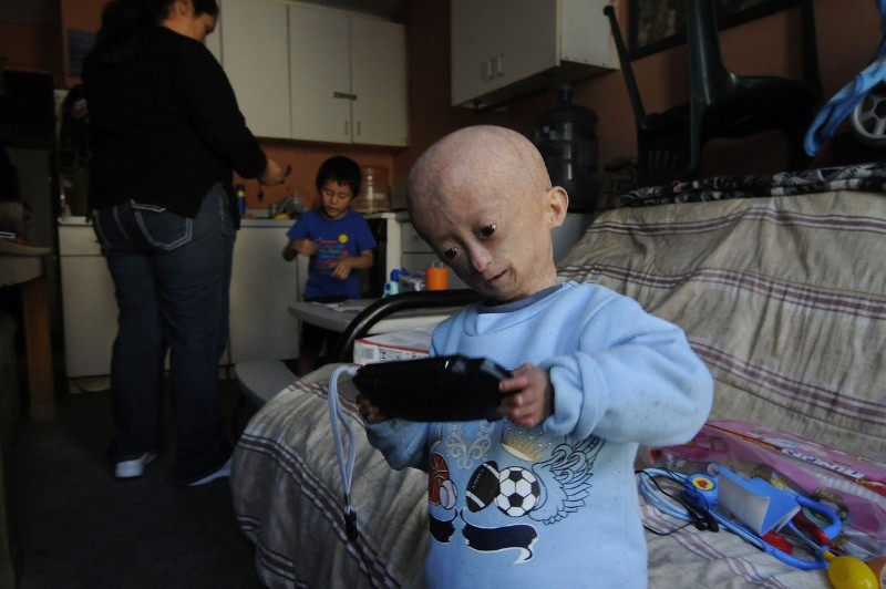 Elías Enoc, padece la enfermedad progeria, la cual causa el envejecimiento prematuro. NOTIMEX / E. Jaramillo 