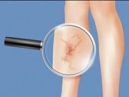 Si las várices provocan dolor constante, cambios en la piel, úlceras o infecciones, es importante buscar atención médica. CANVA