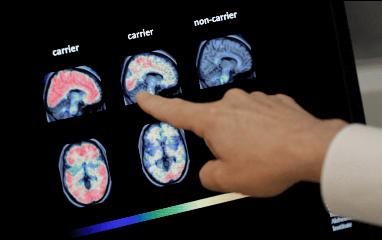 El proyecto, dirigido a ancianos sanos, con deterioro cognitivo precoz y con fragilidad, busca mejorar las herramientas de diagnóstico y evaluación del Alzheimer. AP / ARCHIVO