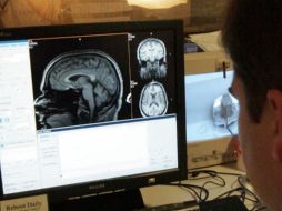 Aunque la epilepsia puede explicarse por genética o lesiones, en muchos casos se desconoce la causa. AP/Archivo