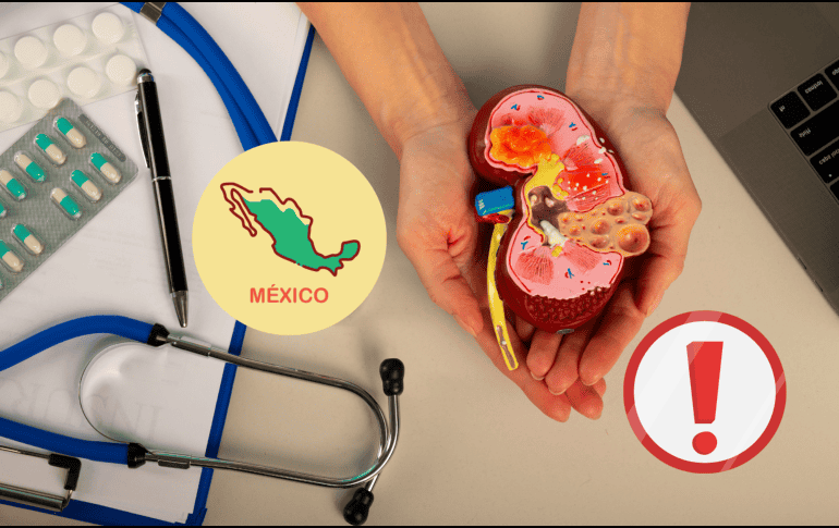 La enfermedad renal crónica (ERC) es una condición que se produce cuando los riñones se dañan y no funcionan correctamente. ESPECIAL