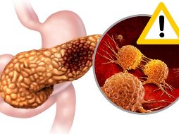 Dado que los primeros síntomas del cáncer de páncreas pueden confundirse con otras enfermedades menos graves, es fundamental acudir a un especialista ante la presencia de estas señales. CANVA