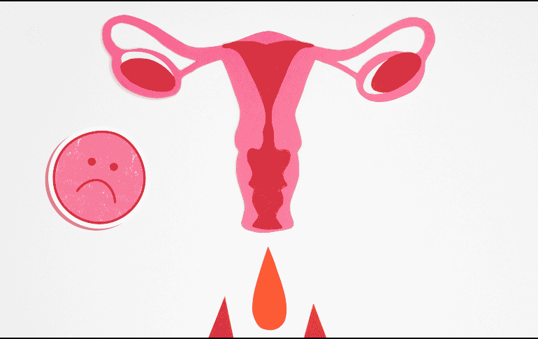 La endometriosis puede confundirse con otras afecciones, como quistes ováricos, enfermedad inflamatoria pélvica o síndrome del intestino irritable. CANVA / N. Moryak