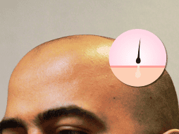 La alopecia androgenética afecta al 50% de los hombres mayores de 50 años y se vuelve cada vez más común con la edad. EL INFORMADOR / ARCHIVO