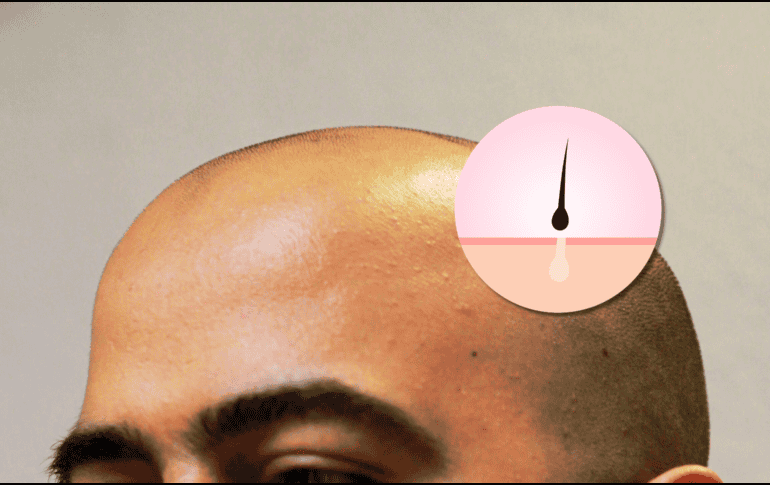 La alopecia androgenética afecta al 50% de los hombres mayores de 50 años y se vuelve cada vez más común con la edad. EL INFORMADOR / ARCHIVO