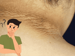 El oscurecimiento del cuello no siempre se debe a falta de higiene, sino que puede ser un síntoma de una condición subyacente. CANVA