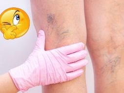 Estos remedios caseros pueden ser de gran ayuda para aliviar los síntomas leves de las várices, pero no sustituyen el diagnóstico ni el tratamiento médico. CANVA