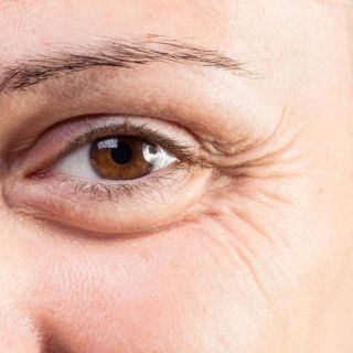 ¿Por qué aparecen bolsas debajo de los ojos?