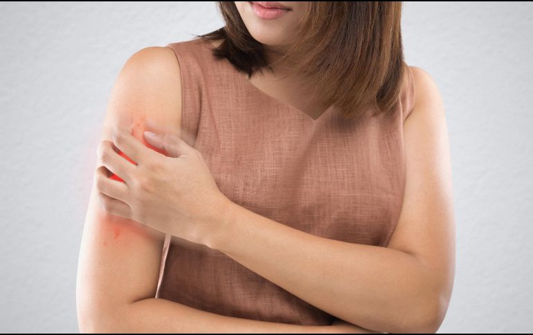 Esta erupción por calor, a primera vista se ve como pequeñas ampollas o bultos inflamados, y pueden provocar ardor y comezón. ESPECIAL / CANVA