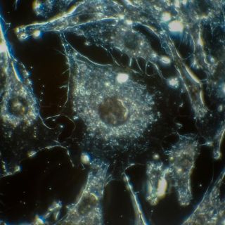 Mejoran detección de micrometástasis en cáncer de colón