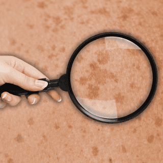 ¿Por qué debes poner atención a tus pecas?