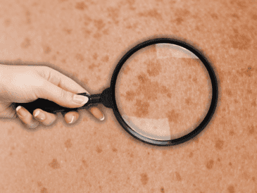 Hay algunas pecas que pueden aparecer y desaparecer conforme nos asoleamos. ESPECIAL / CANVA