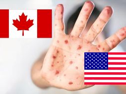 En Estados Unidos se han registrado 800 casos de sarampión durante 2025. ESPECIAL / SUN