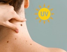 El melanoma, un tumor cutáneo grave, se asemeja a un lunar, pero a menudo con las siguientes características: asimetría, bordes irregulares, varios colores, agrandamiento o cambio de aspecto. ESPECIAL / CANVA