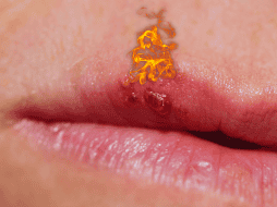 El herpes labial puede durar, generalmente, de una a dos semanas. ESPECIAL / CANVA