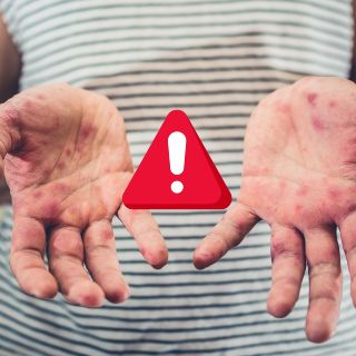 Comité de Vigilancia lanza aviso epidemiológico por sarampión